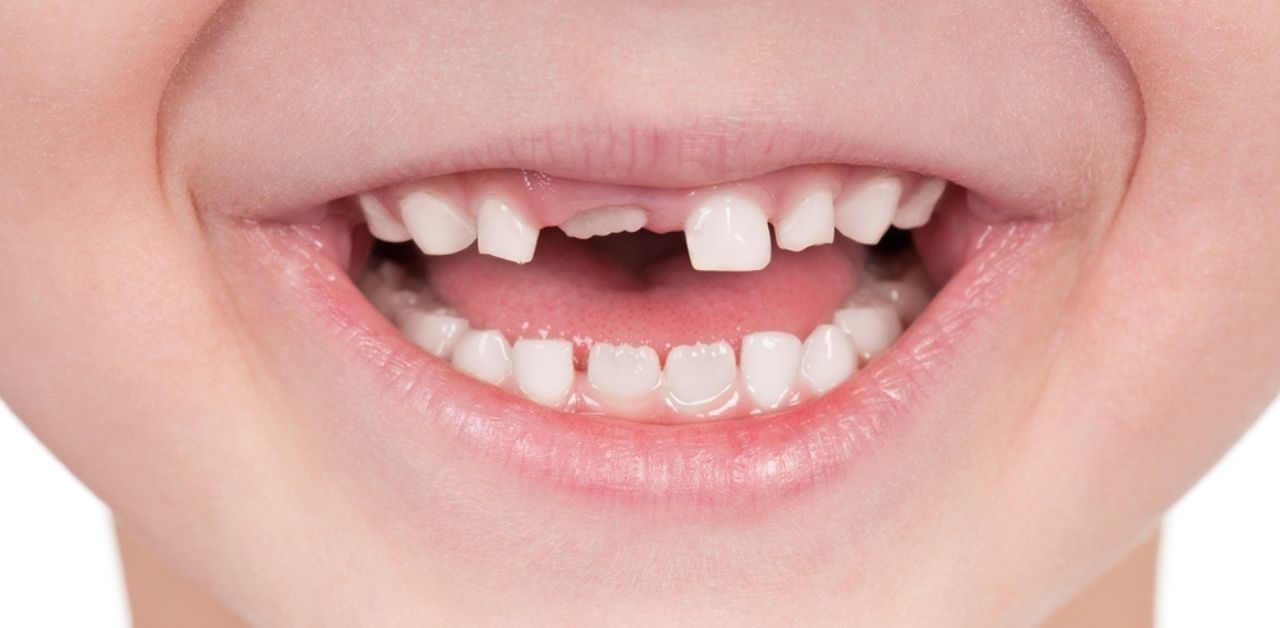 Có bao nhiêu răng sữa phải thay ở trẻ nhỏ?