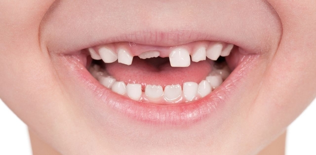 Có bao nhiêu răng sữa phải thay ở trẻ nhỏ?