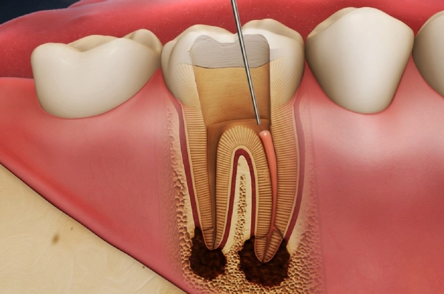 Điều trị viêm quanh cuống răng thế nào?