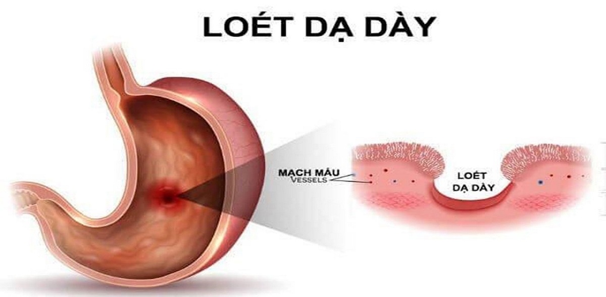 Loét dạ dày và những thông tin hữu ích cần biết