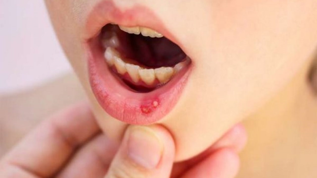 Tìm hiểu các nguyên nhân bị sưng nướu răng 