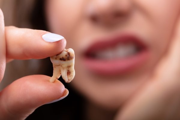 Viêm quanh cuống răng là tình trạng tổn thương các thành phần mô quanh cuống 