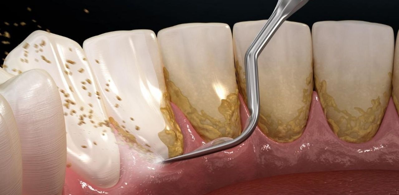 Tìm hiểu quy trình lấy cao răng từ A đến Z