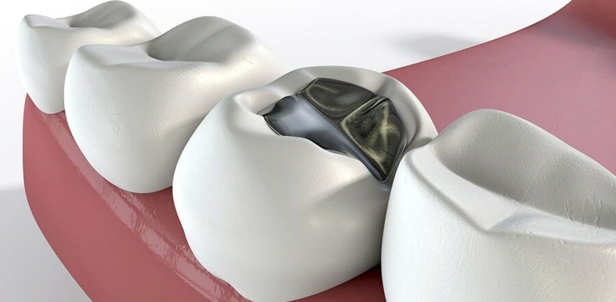 Răng hàm số 6 bị sâu: Nguyên nhân và cách điều trị