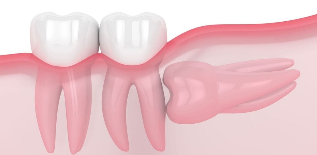 Giải đáp: Răng số 8 mọc ngầm phải làm sao?