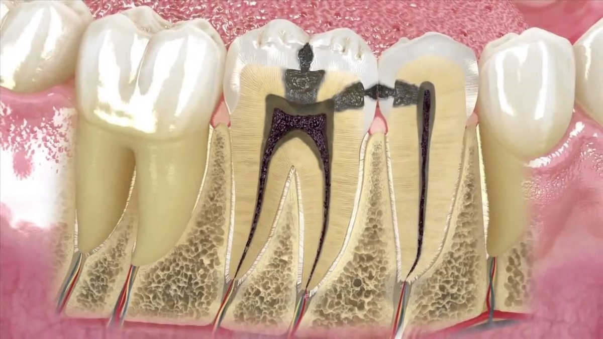 Sâu răng hôi miệng phải làm sao? 