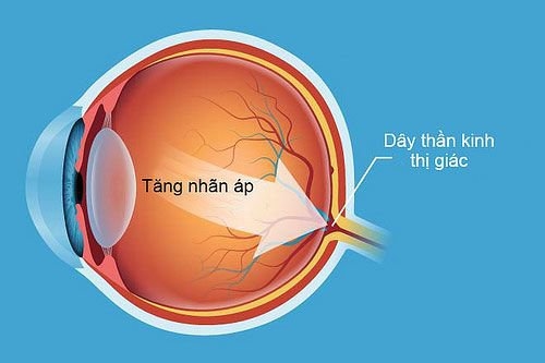 tăng nhãn áp có nguy hiểm không