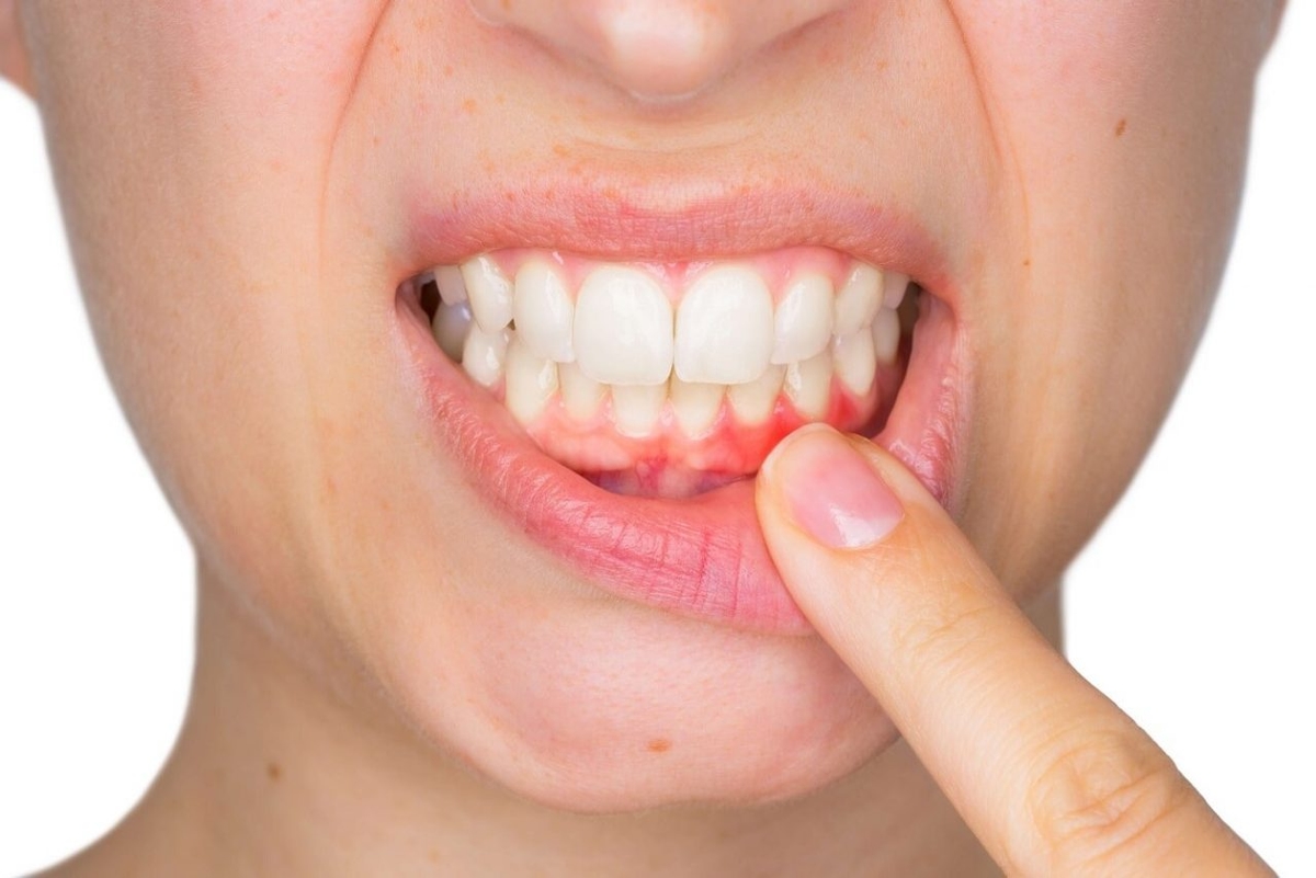 Tìm hiểu viêm lợi phải kiêng ăn gì, nên ăn gì? 