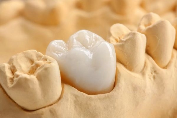Răng sứ titan là một trong những loại răng sứ được ưa chuộng trong việc phục hình thẩm mỹ nha khoa hiện nay