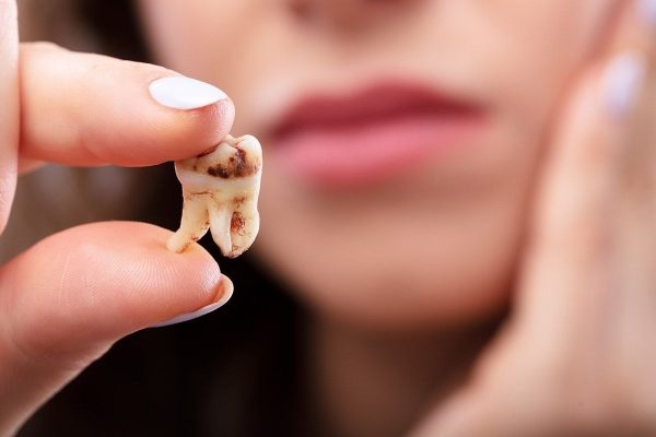 Viêm chân răng là tình trạng các tổ chức quanh răng và chân răng bị vi khuẩn tấn công gây viêm nhiễm
