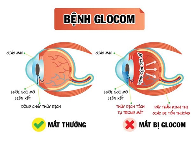 Glocom góc đóng