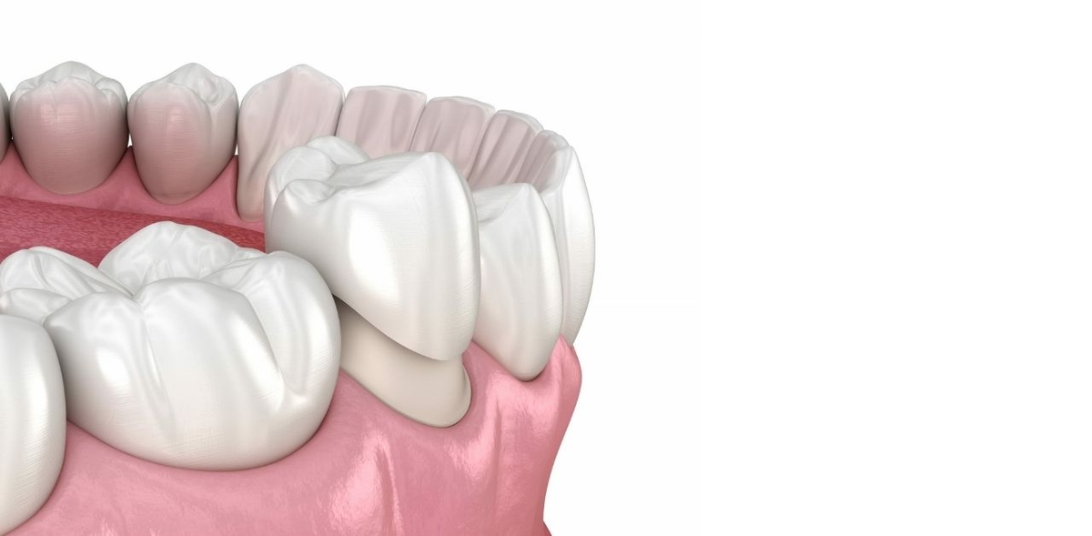 Khi nào nên bọc răng sứ để đạt hiệu quả tốt?