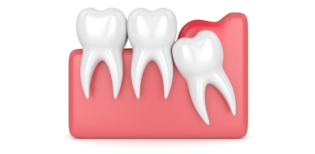 Lợi trùm răng khôn: Dấu hiệu nhận biết và cách xử trí