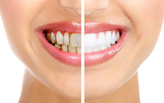 GIẢI ĐÁP: Răng sâu có tẩy trắng được không? 