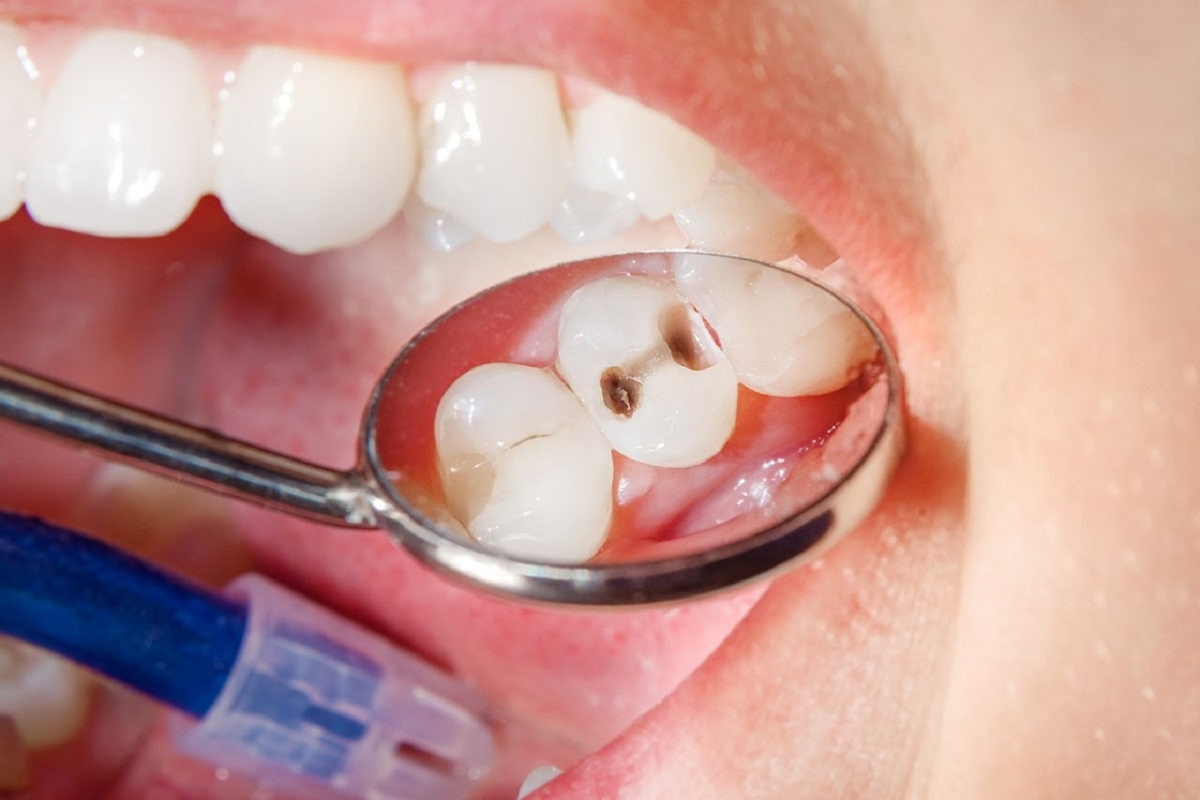 Lý giải nguyên nhân sâu răng dẫn đến hôi miệng 