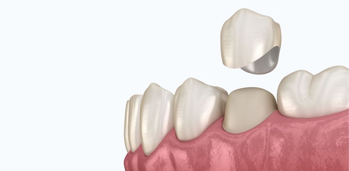 Thời gian bọc răng sứ hoàn thiện mất bao lâu?