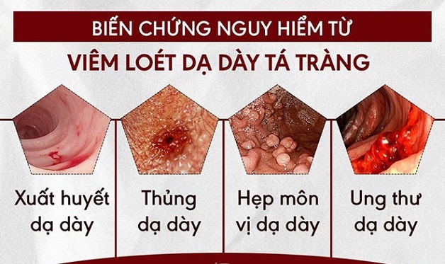 Bệnh nếu không được điều trị sớm sẽ gây ra nhiều biến chứng nguy hiểm