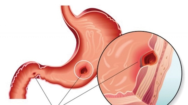 Viêm dạ dày có thể dẫn tới ung thư nếu không điều trị sớm