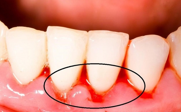 Khi bị viêm lợi, lợi dễ bị tổn thương hay chảy máu dù chỉ là một va chạm nhẹ 
