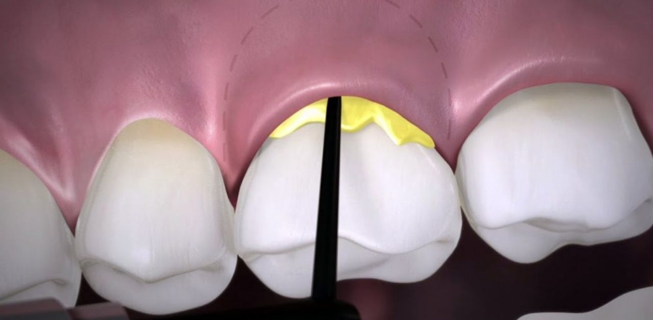 Bác sĩ nha khoa giải đáp: Viêm quanh cuống răng là gì?