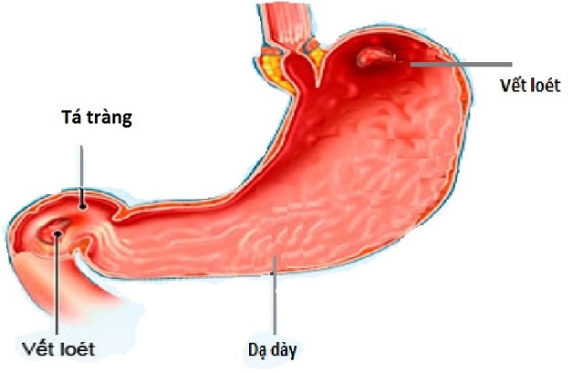 Viêm tá tràng là khi xuất hiện các vết loét trên niêm mạc tá tràng