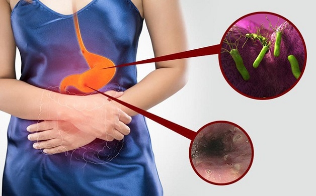 Nguyên nhân chủ yếu gây bệnh thường do nhiễm khuẩn HP