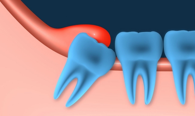 Bệnh viêm lợi trùm: Nguyên nhân và cách điều trị 
