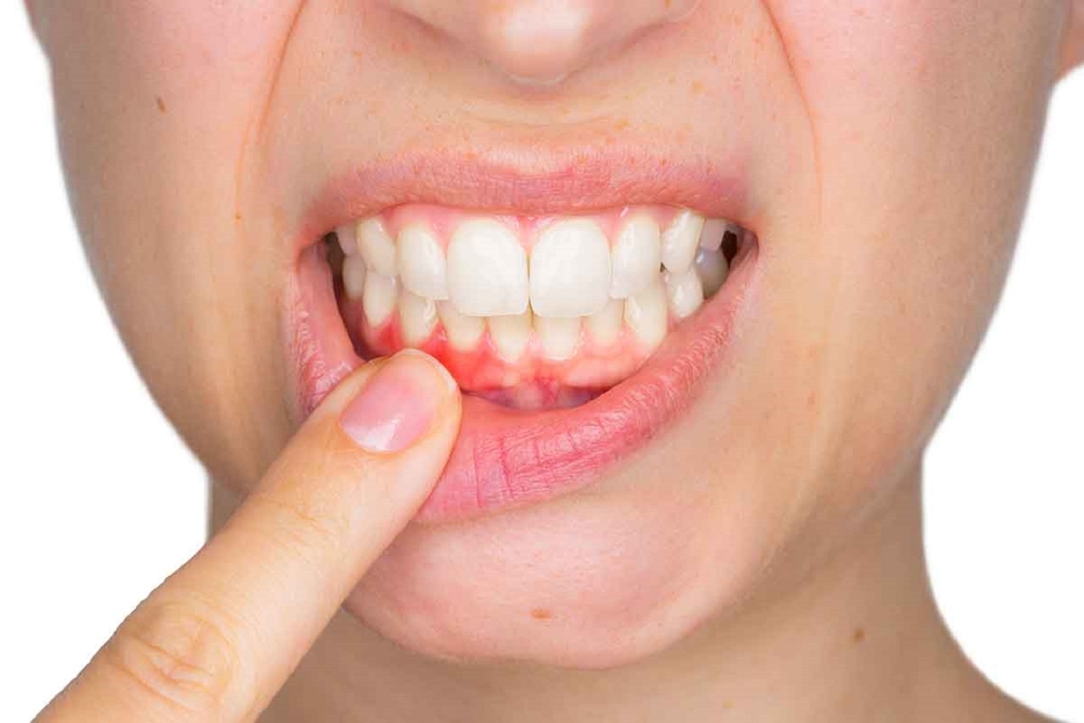 GIẢI ĐÁP: Bị viêm lợi có nên lấy cao răng không? 