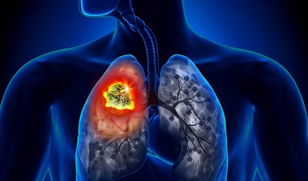 chụp MRI phổi
