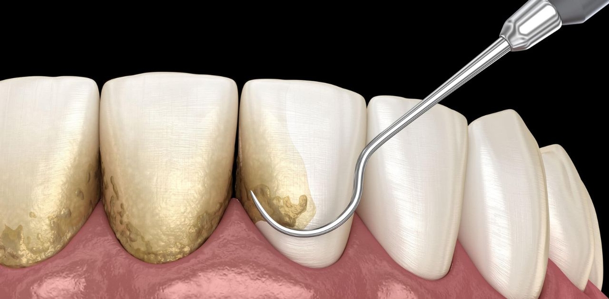 Hướng dẫn chăm sóc răng sau khi lấy cao răng