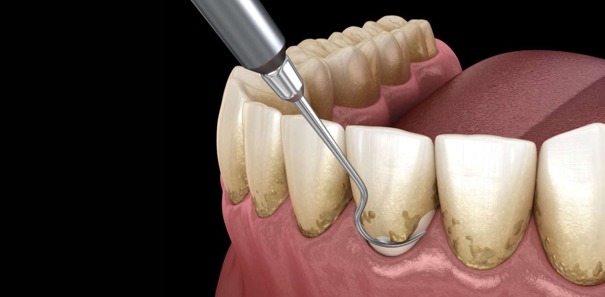 Giải đáp nha khoa: Có nên lấy cao răng không?