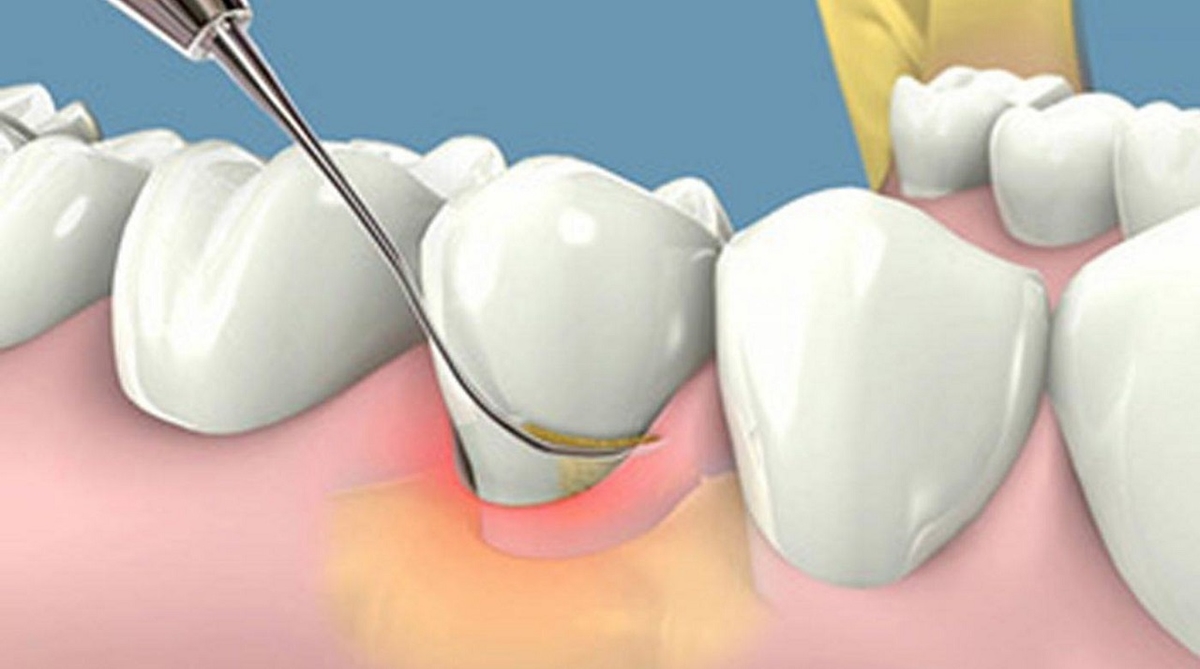 GIẢI ĐÁP: Có nên lấy cao răng thường xuyên không? 