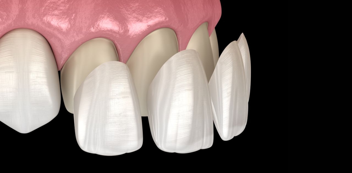 Tuổi thọ răng dán sứ veneer được bao lâu?