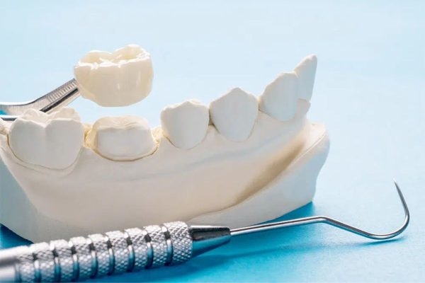 Mão sứ được gắn trực tiếp lên cùi răng thật bằng keo dán chuyên dụng để cố định vĩnh viễn