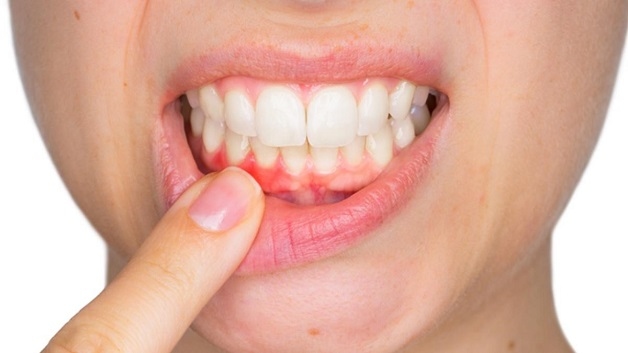 Sưng chân răng hay viêm chân răng là bệnh lý về tổ chức quanh răng bị sưng tấy, viêm nhiễm