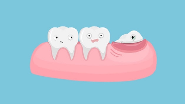 Răng khôn nếu không nhổ bỏ có thể gây các tác động xấu ảnh hưởng trực tiếp tới sức khỏe răng miệng