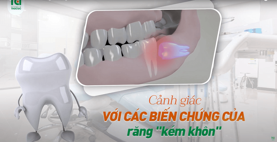 Cảnh giác với các biến chứng của răng khôn