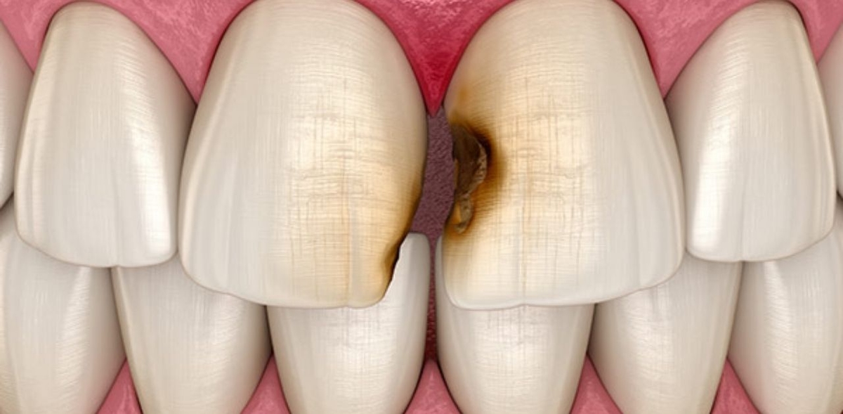 Sâu ở kẽ răng: Nguyên nhân, nhận biết, cách điều trị
