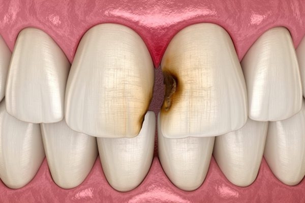 Sâu ở kẽ răng là quá trình tổn thương mô cứng của răng do vi khuẩn gây ra