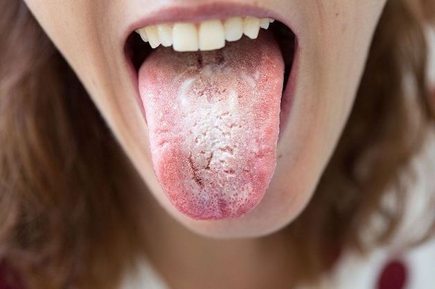 Nấm miệng có thể gặp ở nhiều đối tượng, kể cả trẻ sơ sinh và trẻ nhỏ