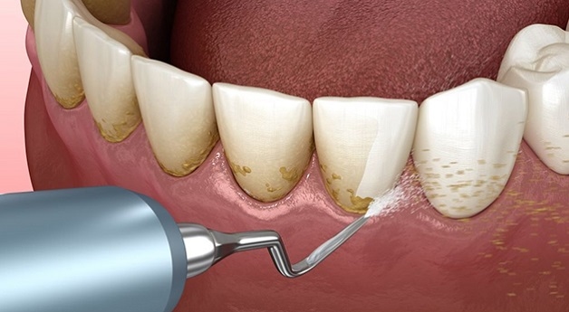 Triệu chứng viêm nha chu ở giai đoạn đầu có thể là hình thành vôi răng/cao răng