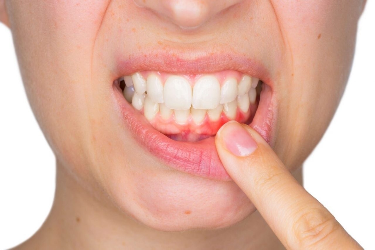 GIẢI ĐÁP: Viêm chân răng kiêng ăn gì, nên ăn gì? 