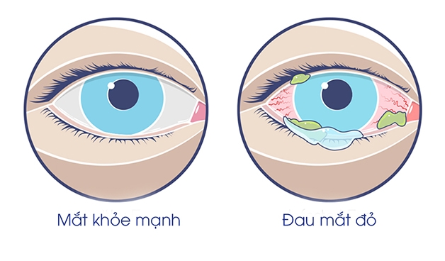 viêm kết mạc