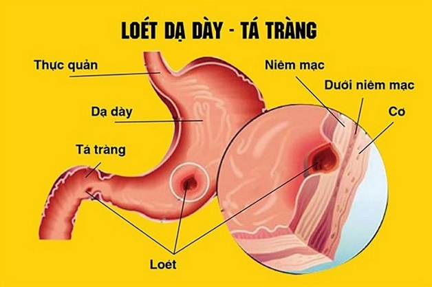 Bệnh tá tràng diễn ra khi trên niêm mạc xuất hiện vết loét