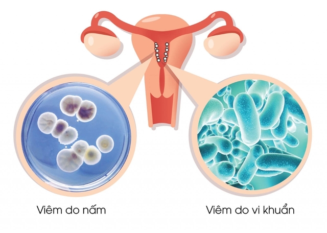Bị nhiễm nấm vùng kín &#8211; Nguyên nhân và cách điều trị?