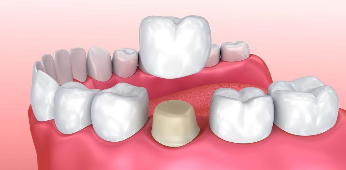 Giải đáp: Phương pháp bọc răng sứ có bền không?