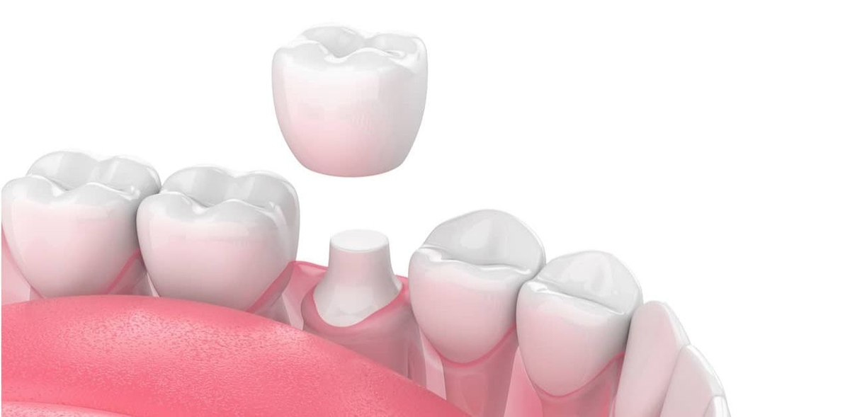 Giải đáp: Bọc răng sứ có phải mài răng không?