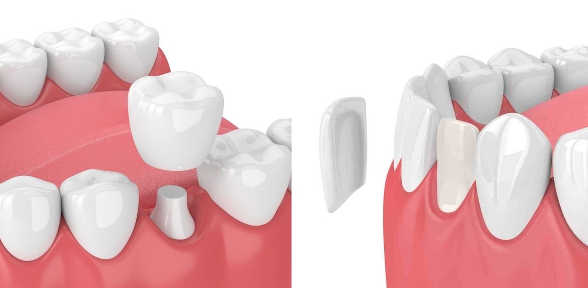 Nên thực hiện bọc răng sứ hay dán veneer cho răng?