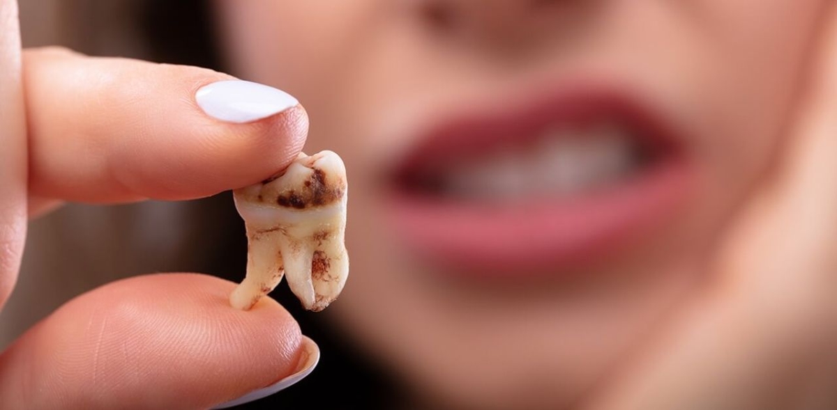 Tìm hiểu cách chữa sâu răng dứt điểm
