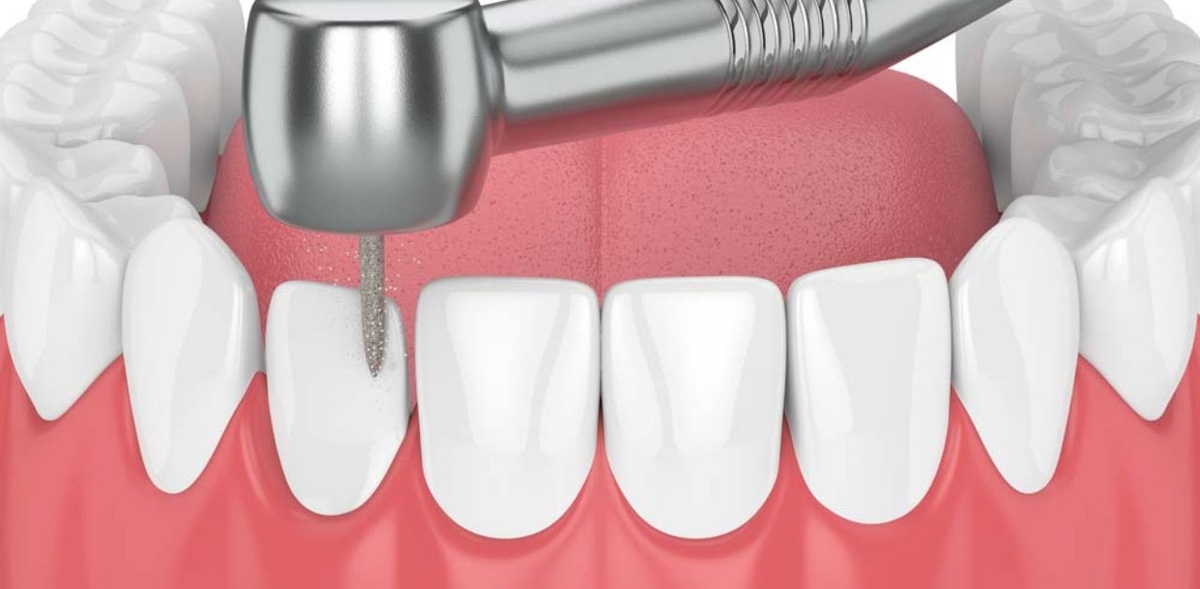 Tìm hiểu dán sứ veneer có mài răng không?